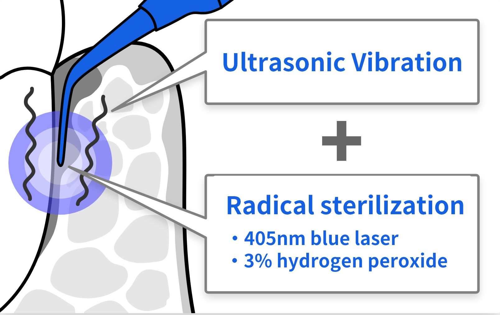 Ultrasonic vibration + radical sterilization