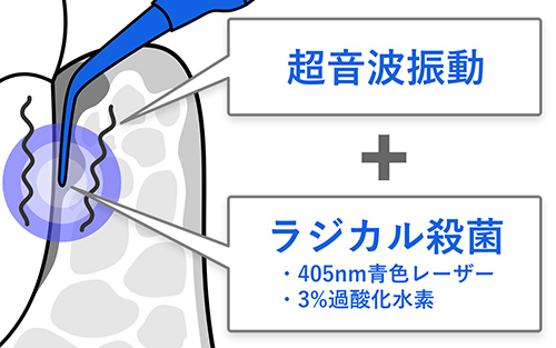 超音波振動 + ラジカル殺菌