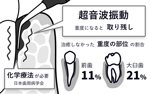超音波振動のみ