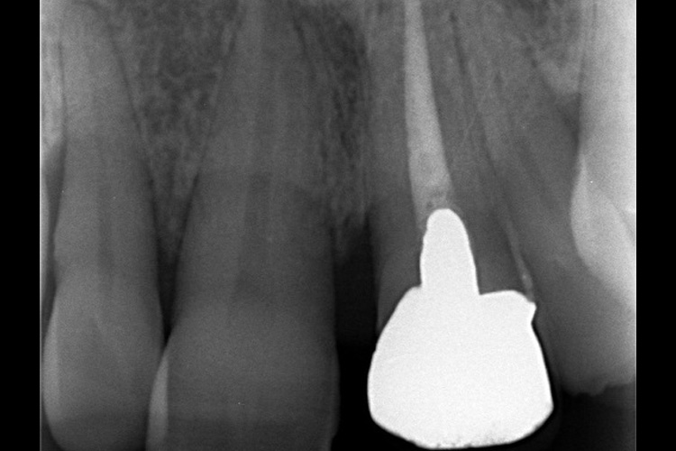 実施前レントゲン