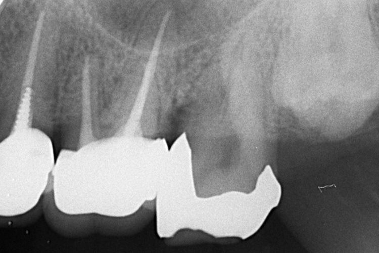 実施前レントゲン